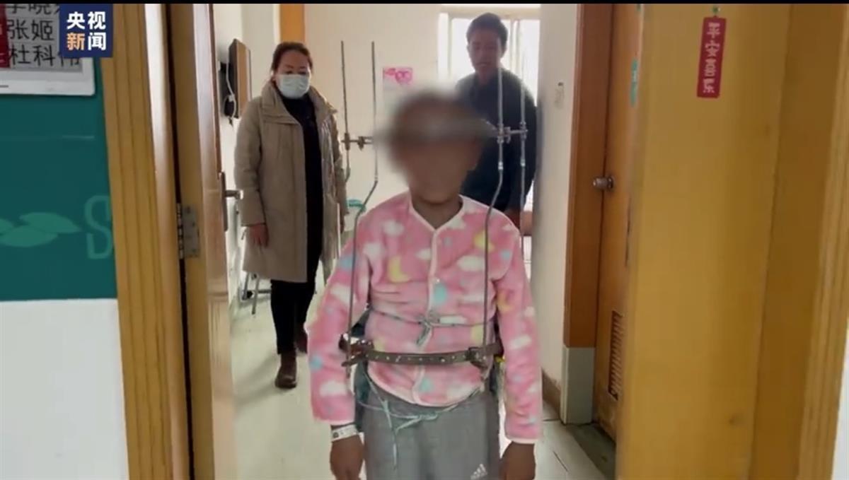 脊柱侧弯女孩术后高了21厘米